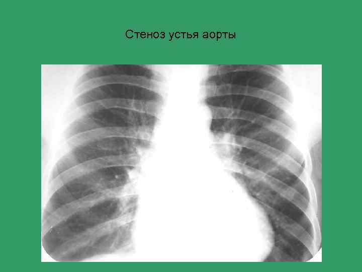 Стеноз устья аорты 