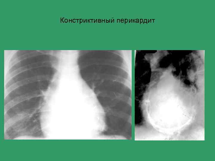Констриктивный перикардит 
