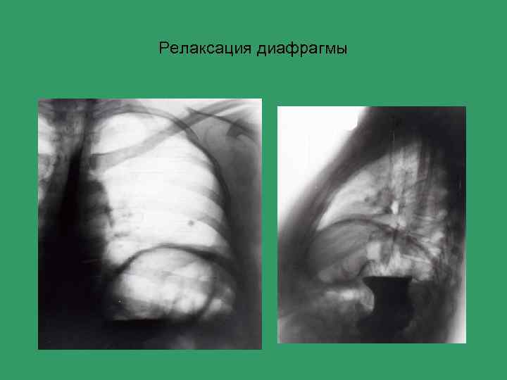 Релаксация диафрагмы 