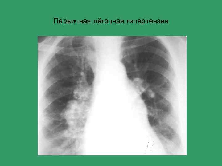 Первичная лёгочная гипертензия 