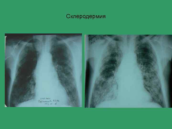 Склеродермия 