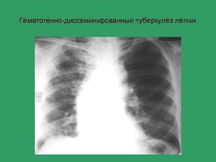 Острый диссеминированный туберкулез. Подострый диссеминированный туберкулез рентген. Острый диссеминированный туберкулез рентген. Диссеминированный инфильтративный туберкулез. Гематогенно диссеминированный туберкулез рентген.