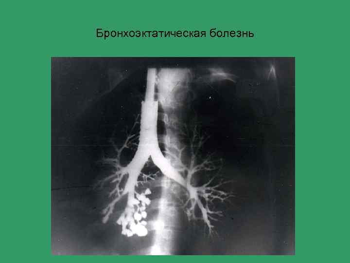 Бэб это. Бронхография при бронхоэктатической болезни. Бронхоэктатическая болезнь (Бэб). Бронхоэктатическая болезнь легких диагностика.