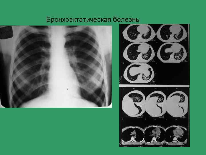 Бронхоэктатическая болезнь 