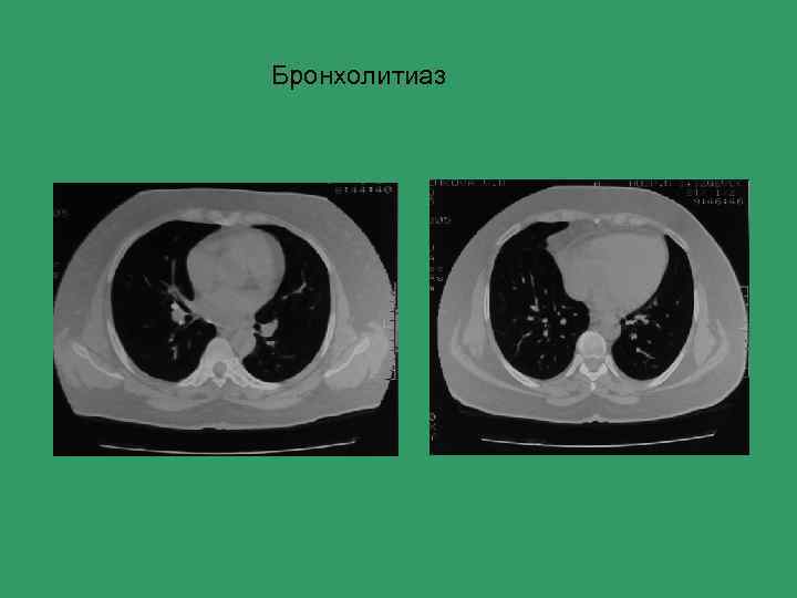 Бронхолитиаз 