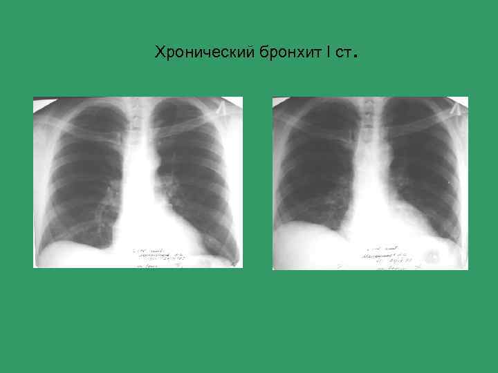 Хронический бронхит I ст . 