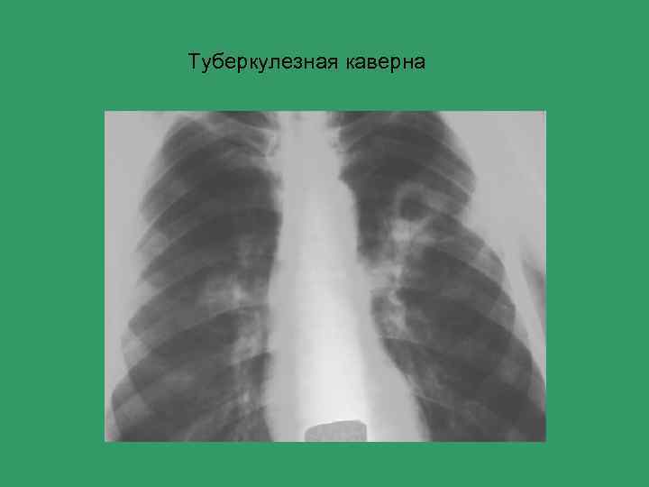 Туберкулезная каверна 