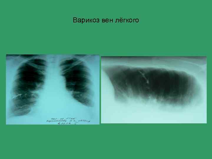 Варикоз вен лёгкого 