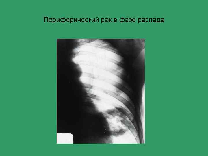 Периферический рак в фазе распада 