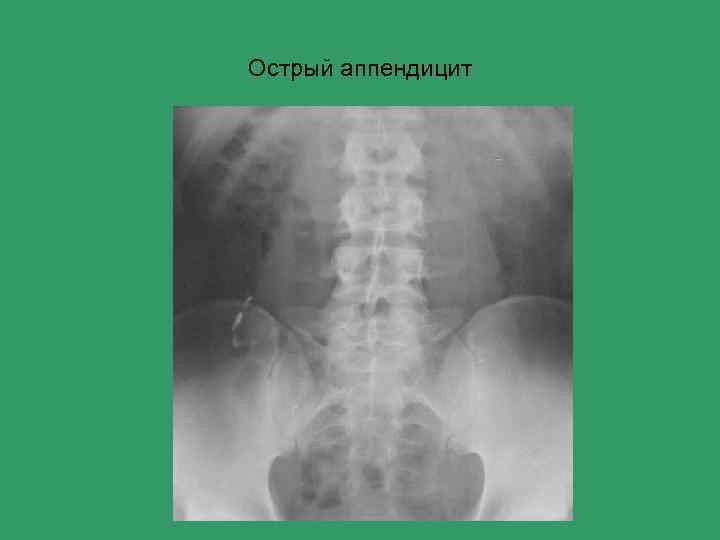 Острый аппендицит 