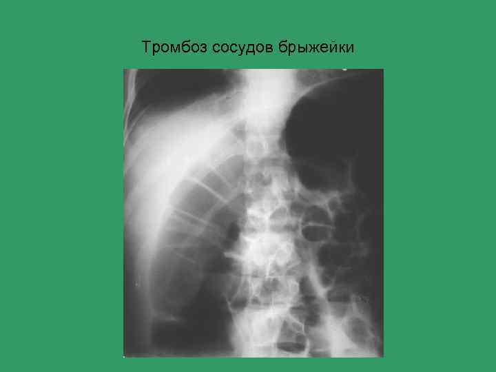 Тромбоз сосудов брыжейки 