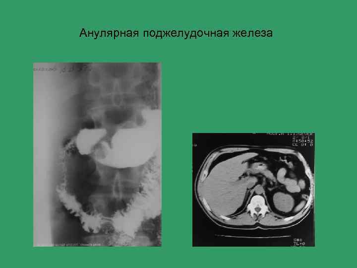 Анулярная поджелудочная железа 