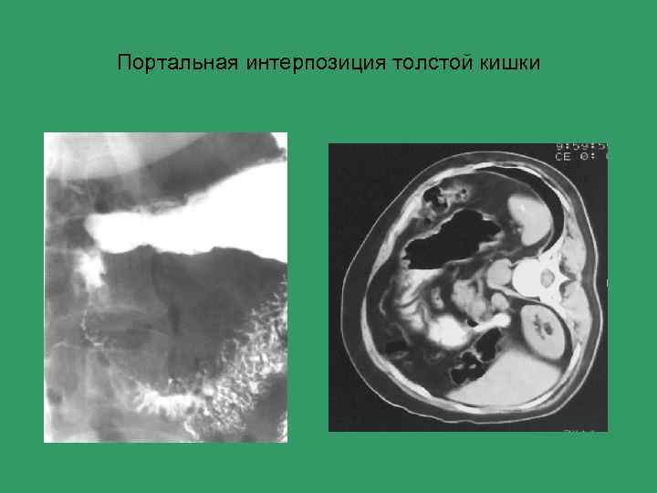 Портальная интерпозиция толстой кишки 