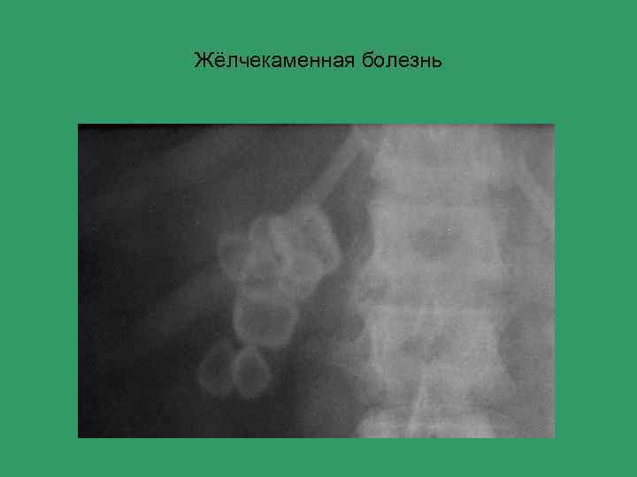 Жёлчекаменная болезнь 