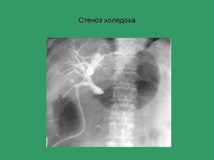 Стеноз холедоха 