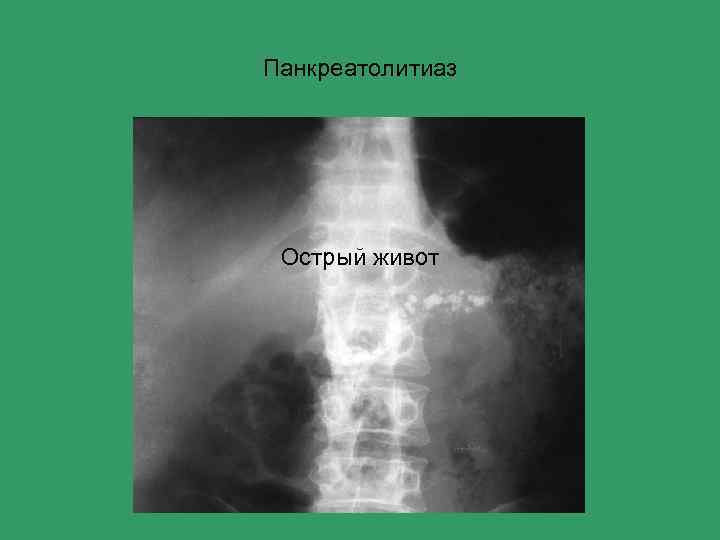 Панкреатолитиаз Острый живот 