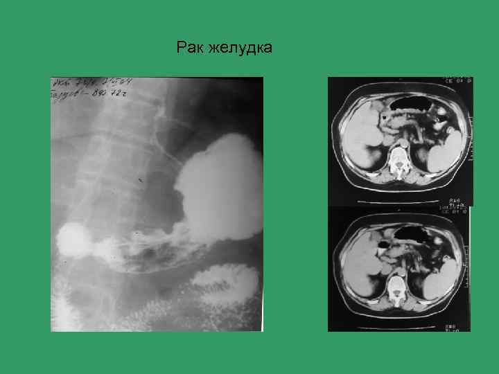 Рак желудка 