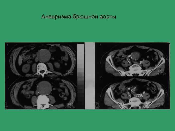 Аневризма брюшной аорты 