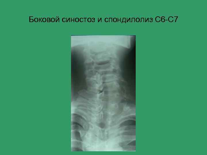 Боковой синостоз и спондилолиз С 6 -С 7 