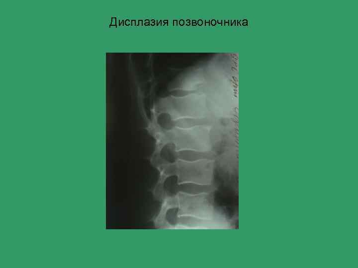 Дисплазия позвоночника 