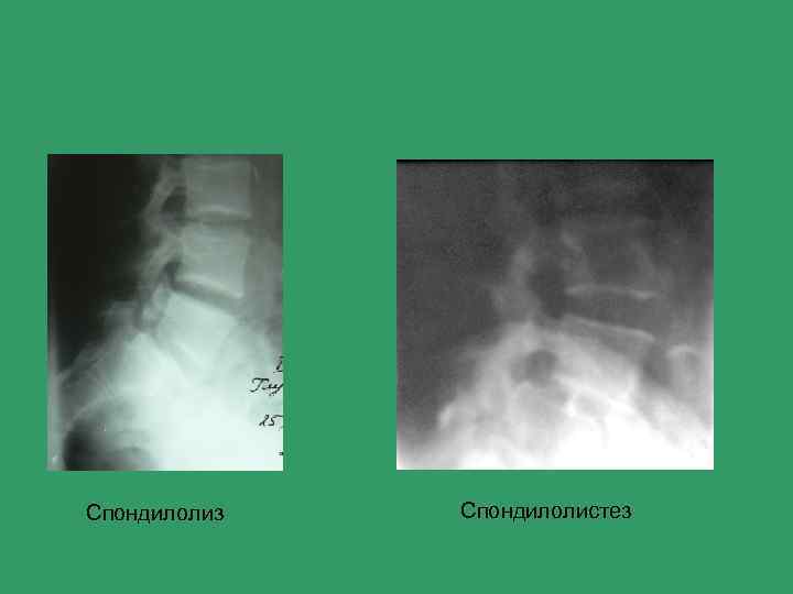 Спондилолиз Спондилолистез 