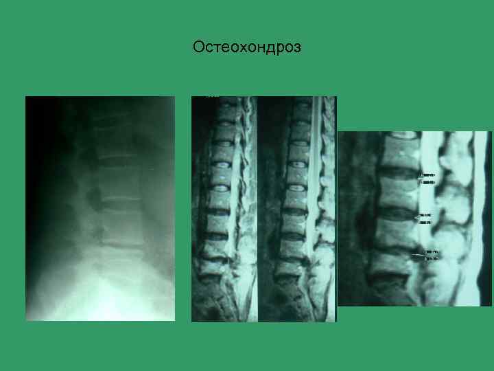 Остеохондроз 