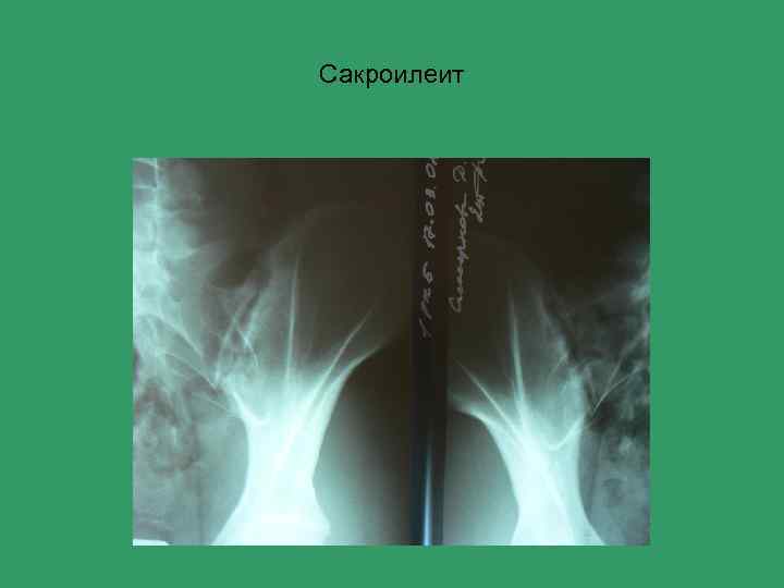 Сакроилеит 