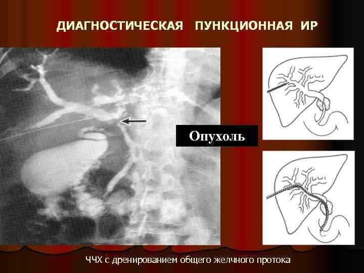 ДИАГНОСТИЧЕСКАЯ ПУНКЦИОННАЯ ИР Опухоль ЧЧХ с дренированием общего желчного протока 