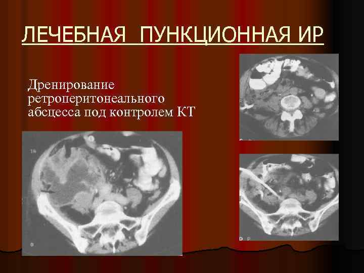 ЛЕЧЕБНАЯ ПУНКЦИОННАЯ ИР Дренирование ретроперитонеального абсцесса под контролем КТ 