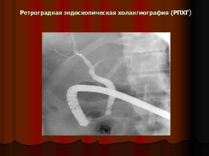 Ретроградная эндоскопическая холангиография (РПХГ) 