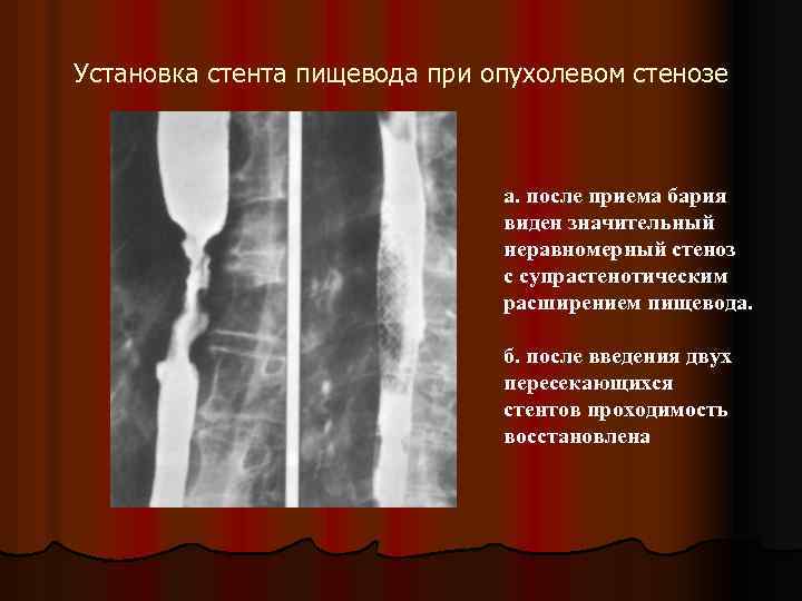Установка стента пищевода при опухолевом стенозе а. после приема бария виден значительный неравномерный стеноз