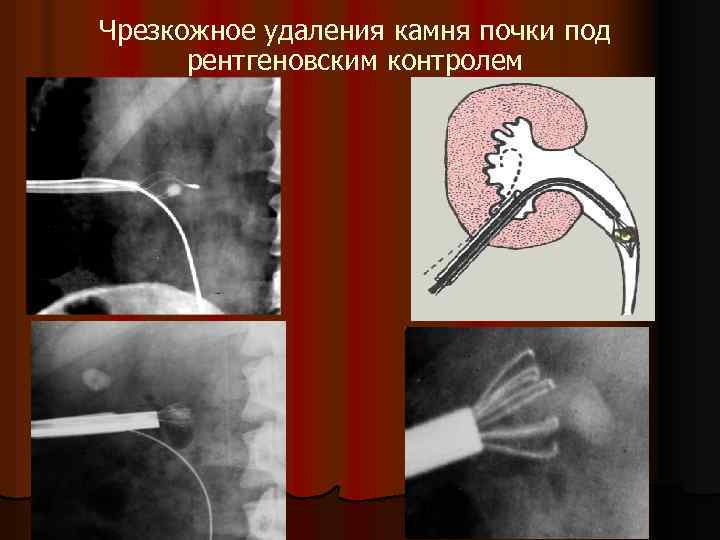 Чрезкожное удаления камня почки под рентгеновским контролем 