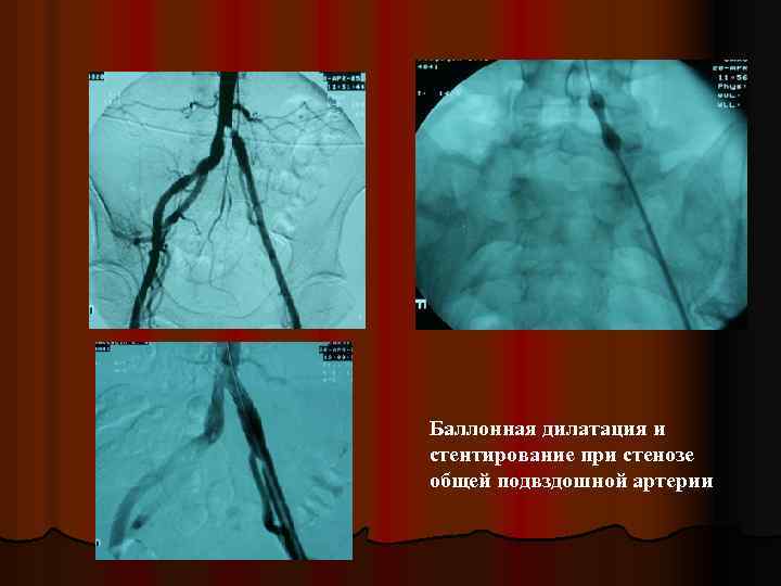 Баллонная дилатация и стентирование при стенозе общей подвздошной артерии 