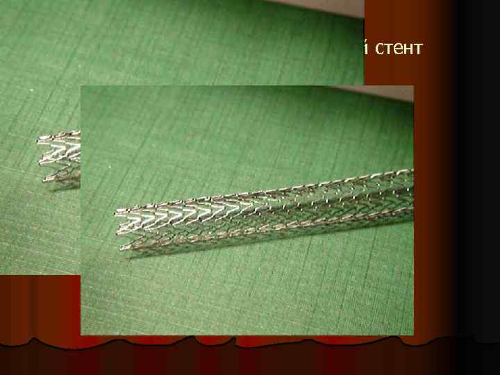 Нитиноловый внутрисосудистый стент 