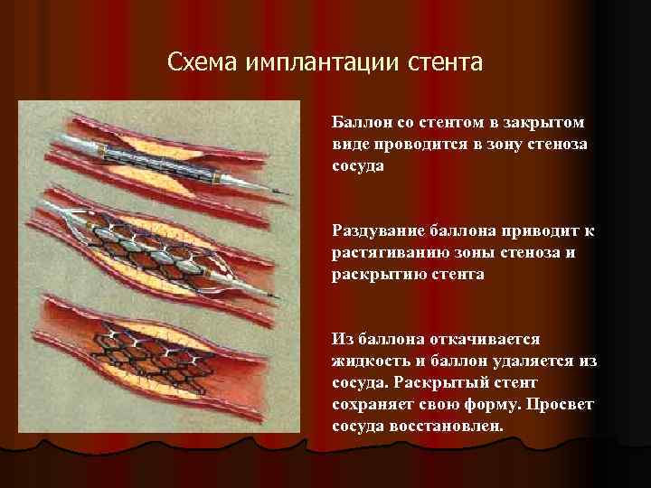 Схема имплантации стента Баллон со стентом в закрытом виде проводится в зону стеноза сосуда