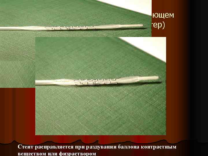 Коронарный стент на доставляющем устройстве (баллонный катетер) Стент расправляется при раздувании баллона контрастным веществом