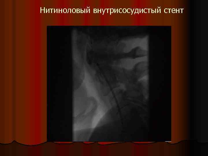 Нитиноловый внутрисосудистый стент 