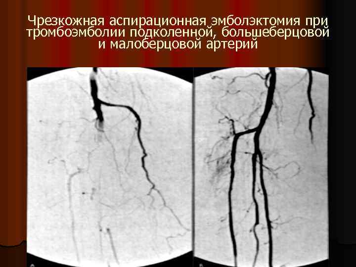 Чрезкожная аспирационная эмболэктомия при тромбоэмболии подколенной, большеберцовой и малоберцовой артерий 