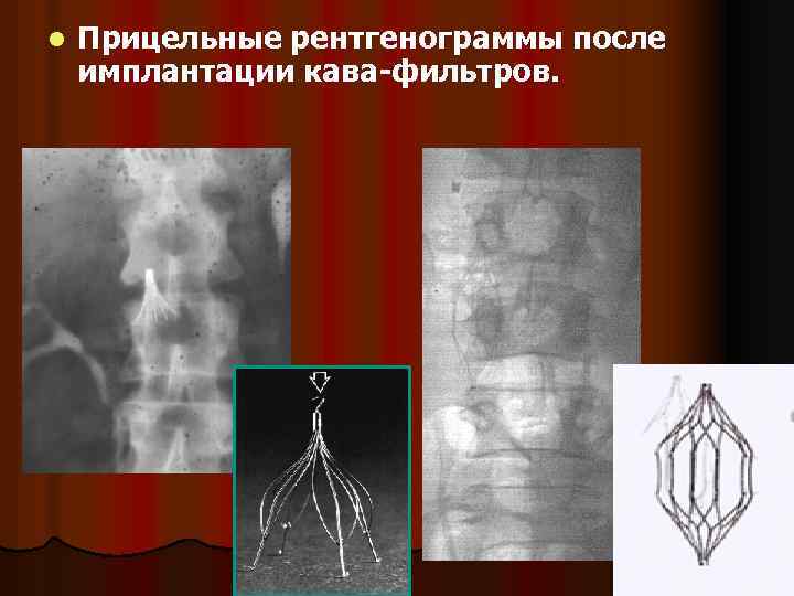 l Прицельные рентгенограммы после имплантации кава-фильтров. 