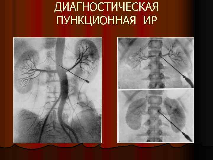 ДИАГНОСТИЧЕСКАЯ ПУНКЦИОННАЯ ИР 