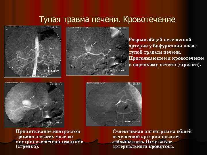 Тупая травма печени. Кровотечение Разрыв общей печеночной артерии у бифуркации после тупой травмы печени.
