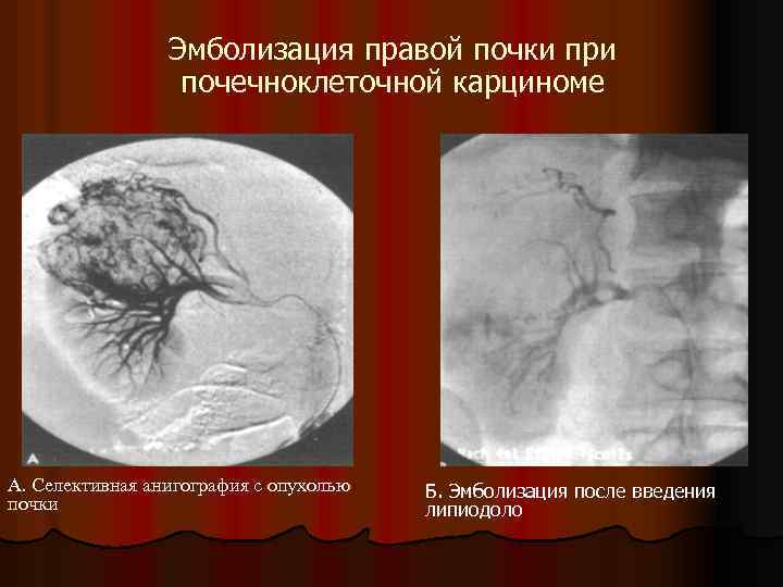 Эмболизация правой почки при почечноклеточной карциноме А. Селективная анигография с опухолью почки Б. Эмболизация