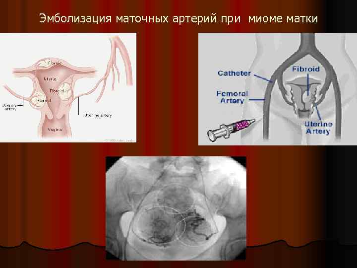 Эмболизация маточных артерий при миоме матки 