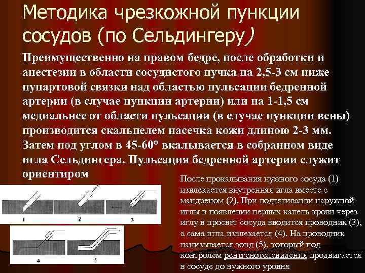 Методика чрезкожной пункции сосудов (по Сельдингеру) Преимущественно на правом бедре, после обработки и анестезии