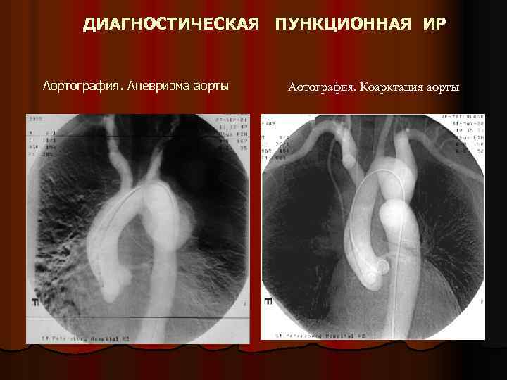 ДИАГНОСТИЧЕСКАЯ ПУНКЦИОННАЯ ИР Аортография. Аневризма аорты Аотография. Коарктация аорты 
