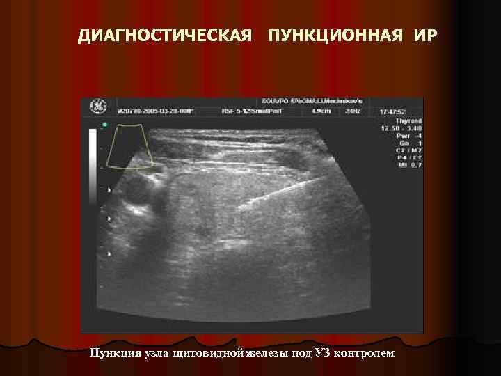 ДИАГНОСТИЧЕСКАЯ ПУНКЦИОННАЯ ИР Пункция узла щитовидной железы под УЗ контролем 