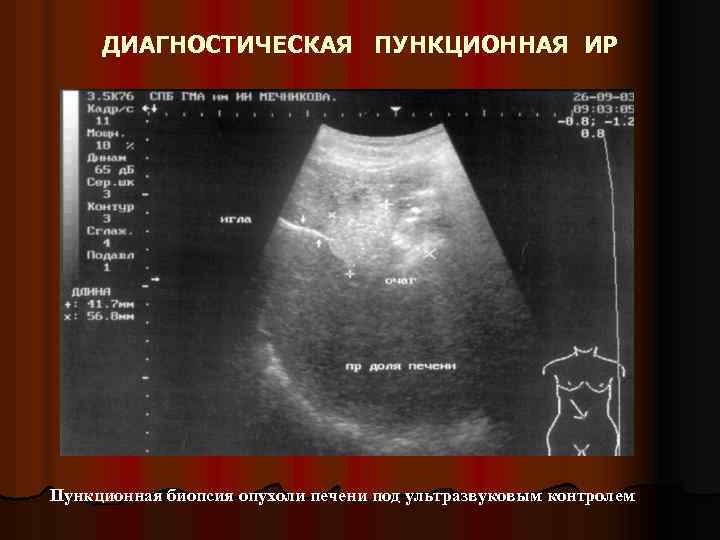 ДИАГНОСТИЧЕСКАЯ ПУНКЦИОННАЯ ИР Пункционная биопсия опухоли печени под ультразвуковым контролем 
