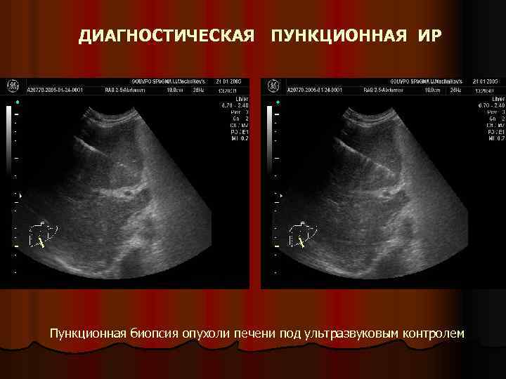 ДИАГНОСТИЧЕСКАЯ ПУНКЦИОННАЯ ИР Пункционная биопсия опухоли печени под ультразвуковым контролем 