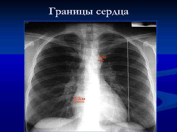 Границы сердца 1 см 2 -3 см 
