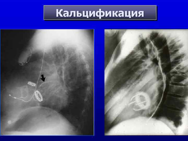 Кальцификация Лев. перед. нисход Опоясывающ арт. 